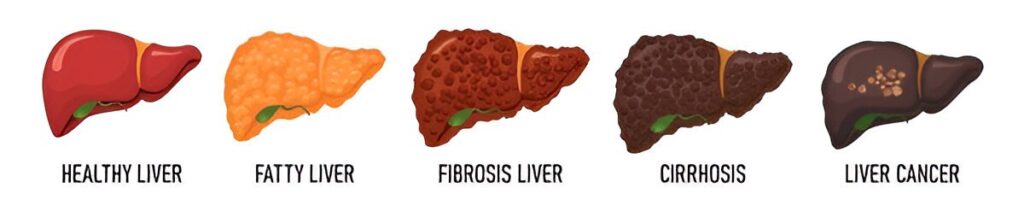 Advanced Liver Disease