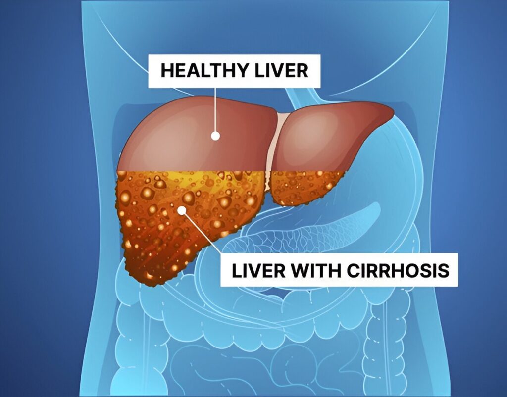 Complications of Cirrhosis