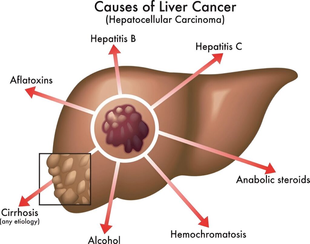 Hepatocellular Carcinoma