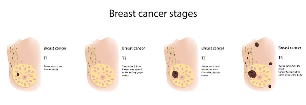 woman-breast-cancer-stages