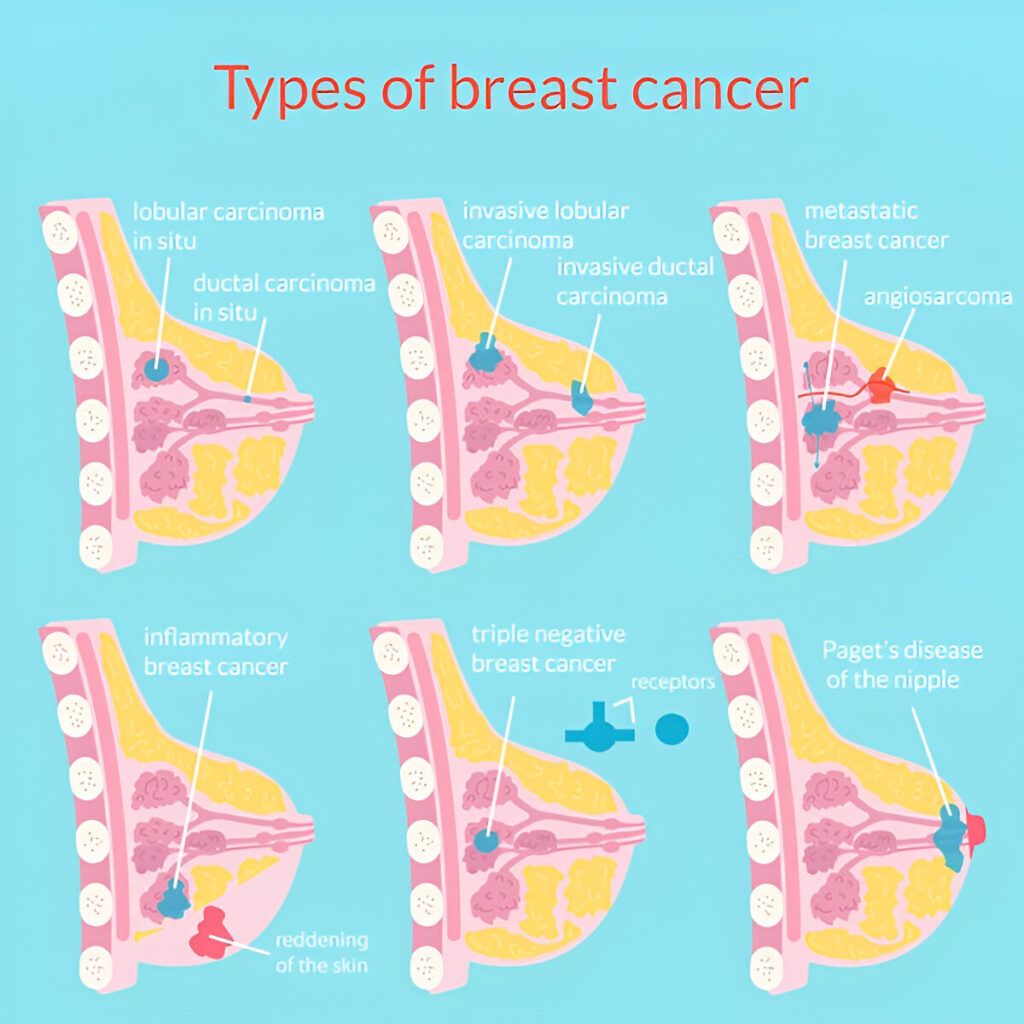 types-breast-cancer-medical-poster