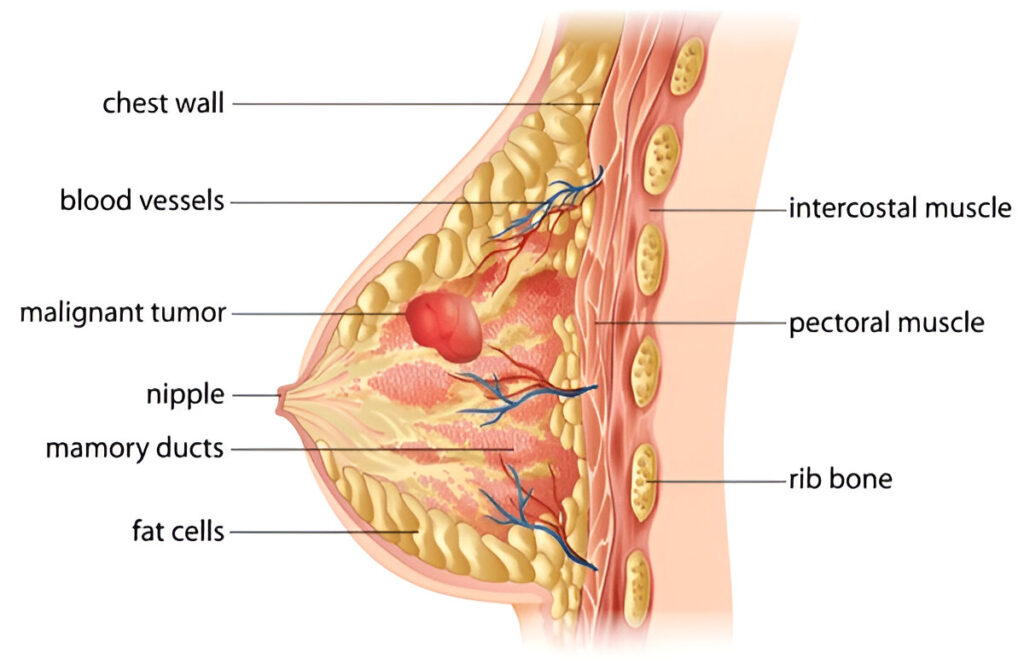 What is Breast Cancer?