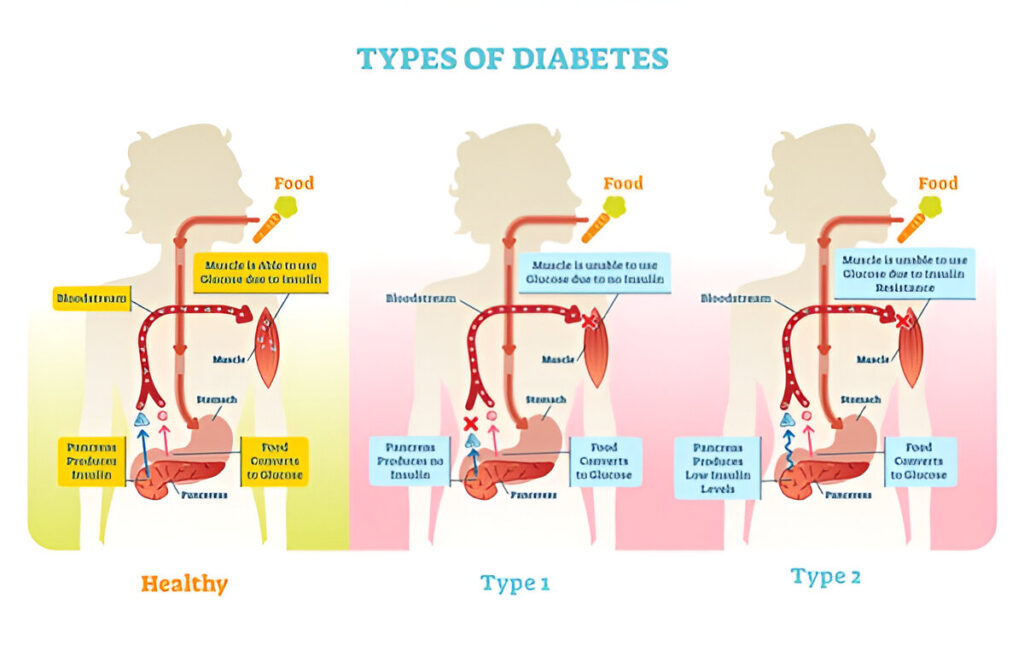 Types of Diabetes 