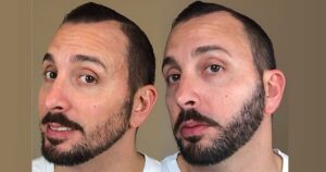 how to fix patchy beard