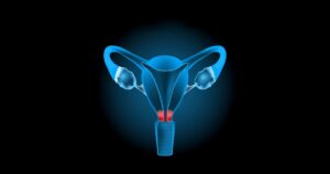 Cervical Cancer: Know the Causes and Prevention Strategies