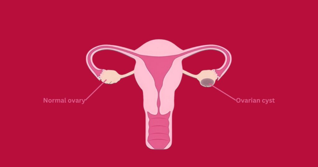 Comparison between normal ovary and ovarian cyst