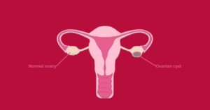 Comparison between normal ovary and ovarian cyst