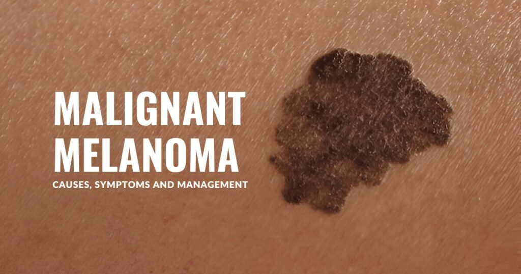 Malignant Melanoma: Causes, Symptoms and Management