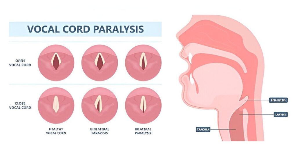 Vocal Cord Paralysis