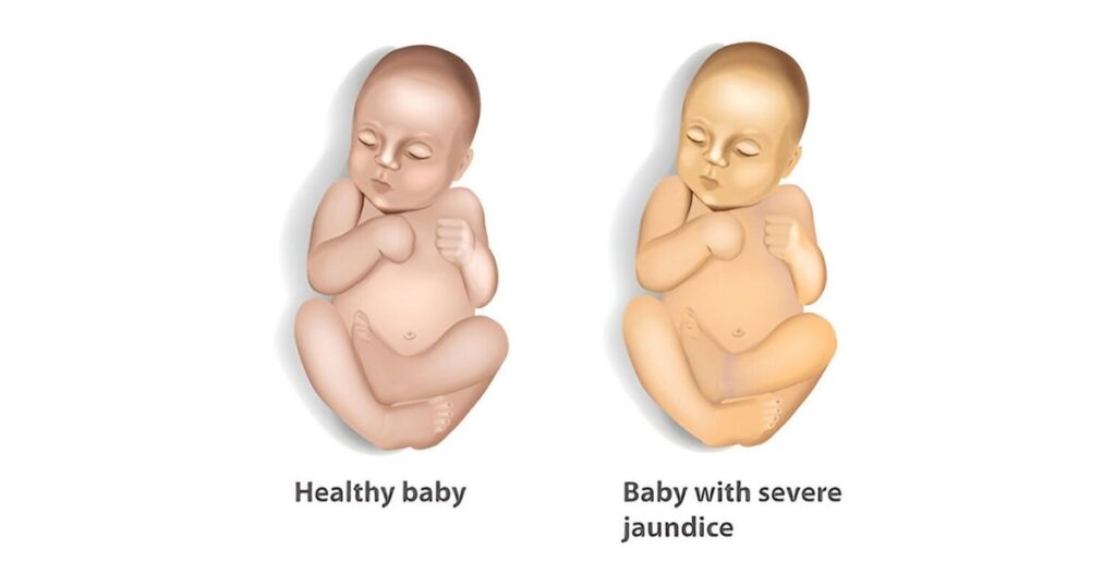 Newborn Jaundice