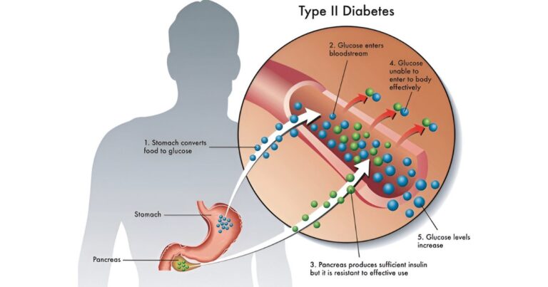 Type 2 Diabetes