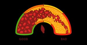 Difference Between Good and Bad Cholesterol